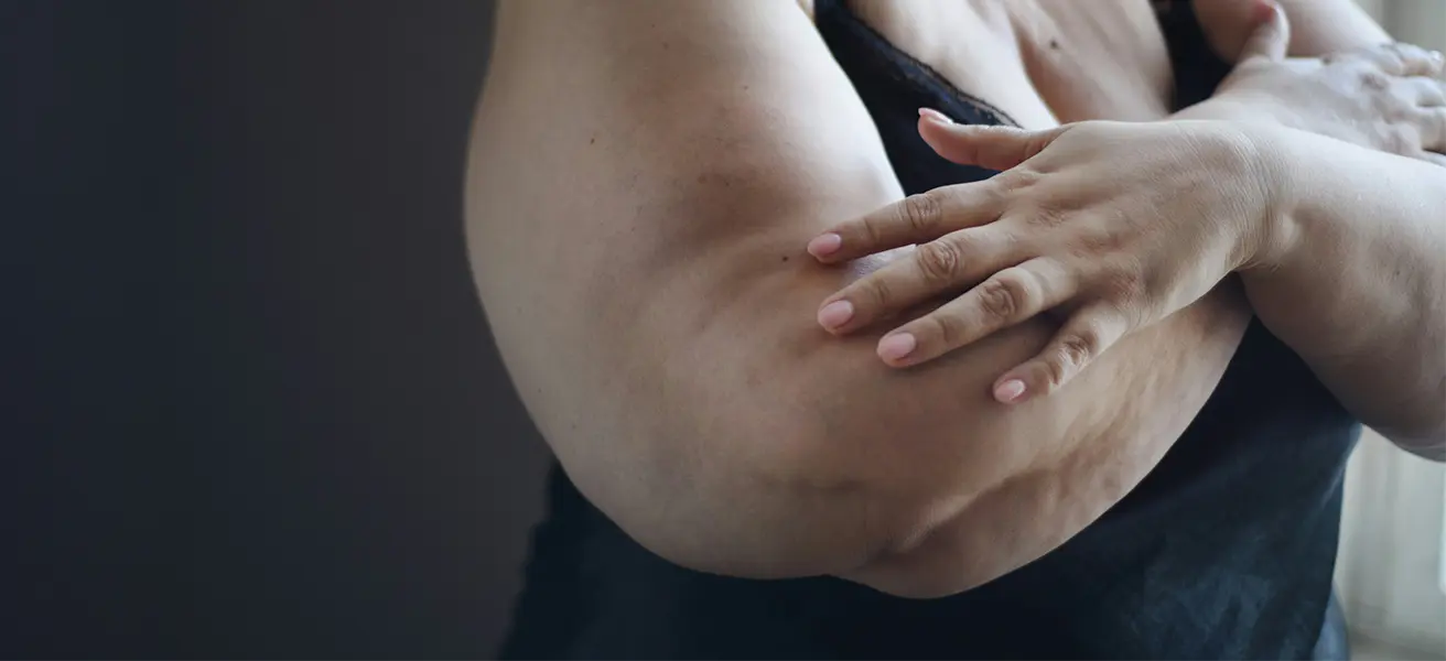 Lipödem erkennen: Warum die richtige Diagnose so wichtig ist